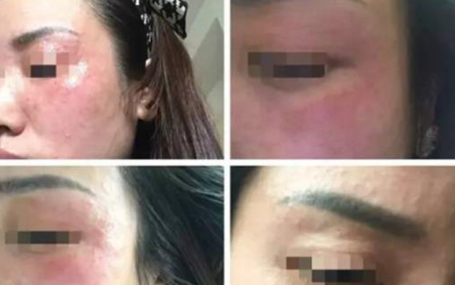 烦恼的痘痘该如何治疗,熙凝颜带你科学祛痘