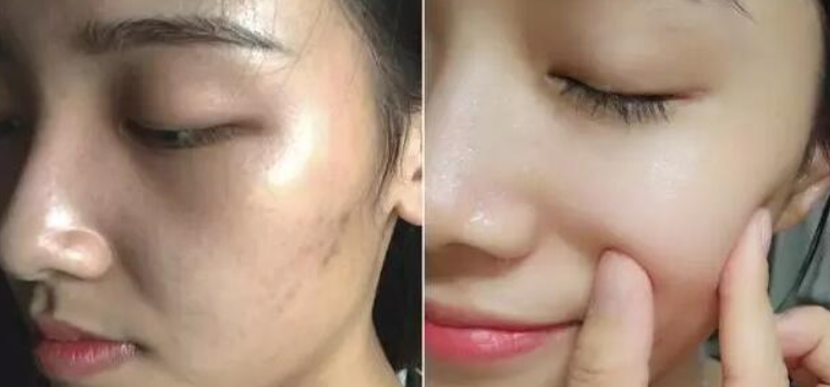 醋泡鸡蛋祛斑吗?熙凝颜告诉你