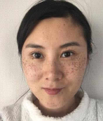 色斑如何防治?