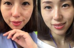 熙凝颜带你简单了解有效的美白祛斑方法